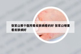 张家口那个医院看皮肤病看的好 张家口哪里看皮肤病好