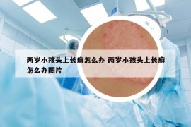 两岁小孩头上长癣怎么办 两岁小孩头上长癣怎么办图片