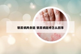 银屑病两条腿 银屑病腿疼怎么回事