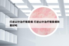 打进口针治疗银屑病 打进口针治疗银屑病效果好吗