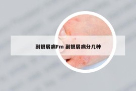 副银屑病Fm 副银屑病分几种