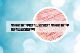 银屑病治疗中医好还是西医好 银屑病治疗中医好还是西医好呢