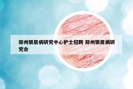 郑州银屑病研究中心护士招聘 郑州银屑病研究会