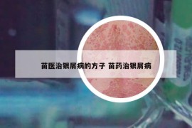 苗医治银屑病的方子 苗药治银屑病