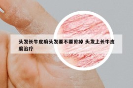 头发长牛皮癣头发要不要剪掉 头发上长牛皮廨治疗