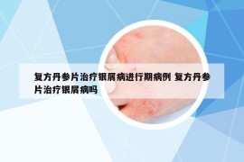 复方丹参片治疗银屑病进行期病例 复方丹参片治疗银屑病吗