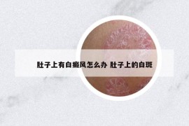 肚子上有白癜风怎么办 肚子上的白斑