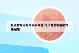 托法替尼治疗牛皮癣用量 托法替尼银屑病效果贴吧