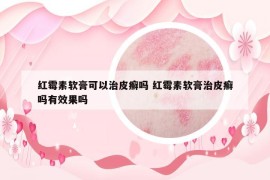 红霉素软膏可以治皮癣吗 红霉素软膏治皮癣吗有效果吗