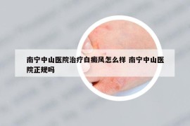 南宁中山医院治疗白癜风怎么样 南宁中山医院正规吗