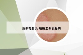 胎癣是什么 胎癣怎么引起的