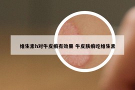 维生素h对牛皮癣有效果 牛皮肤癣吃维生素