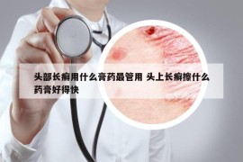 头部长癣用什么膏药最管用 头上长癣擦什么药膏好得快