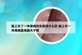 腿上长了一块像癣的东西用什么药 腿上长一块像癣越来越大干痒