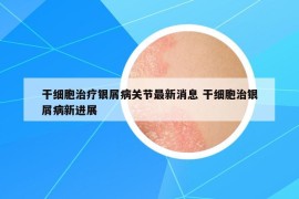 干细胞治疗银屑病关节最新消息 干细胞治银屑病新进展