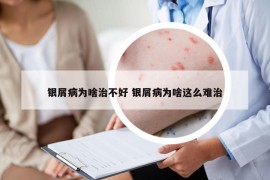 银屑病为啥治不好 银屑病为啥这么难治