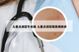 儿童点滴型牛皮癣 儿童点滴型银屑病症状