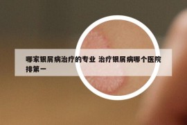 哪家银屑病治疗的专业 治疗银屑病哪个医院排第一