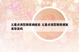 儿童点滴型银屑病痊愈 儿童点滴型银屑病复发率高吗