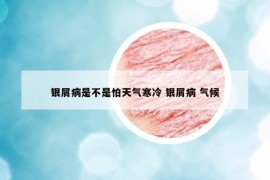 银屑病是不是怕天气寒冷 银屑病 气候