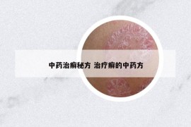 中药治癣秘方 治疗癣的中药方