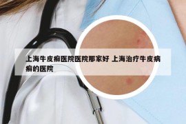 上海牛皮癣医院医院那家好 上海治疗牛皮病癣的医院