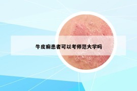 牛皮癣患者可以考师范大学吗