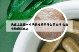 头皮上出现一小块头皮癣用什么药治疗 头皮有块癣怎么办