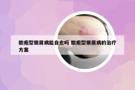 脓疱型银屑病能自愈吗 脓疱型银屑病的治疗方案