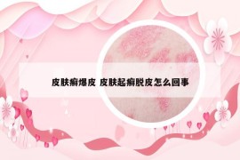 皮肤癣爆皮 皮肤起癣脱皮怎么回事