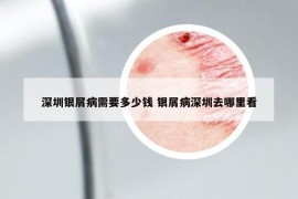 深圳银屑病需要多少钱 银屑病深圳去哪里看