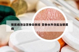 银屑病泡浴苦参白鲜皮 苦参水外洗能治银屑病