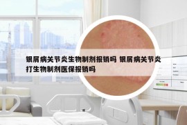 银屑病关节炎生物制剂报销吗 银屑病关节炎打生物制剂医保报销吗