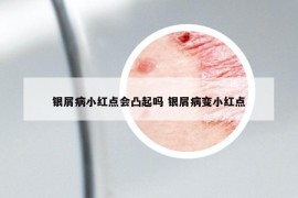 银屑病小红点会凸起吗 银屑病变小红点