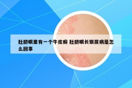 肚脐眼里有一个牛皮癣 肚脐眼长银屑病是怎么回事