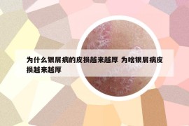 为什么银屑病的皮损越来越厚 为啥银屑病皮损越来越厚