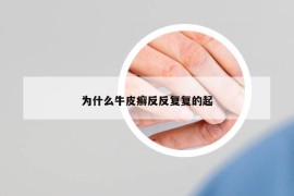 为什么牛皮癣反反复复的起