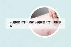 小腿突然长了一块癣 小腿突然长了一块癣很痒