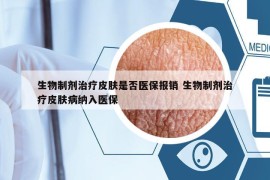 生物制剂治疗皮肤是否医保报销 生物制剂治疗皮肤病纳入医保