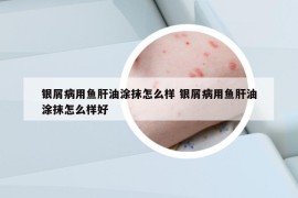 银屑病用鱼肝油涂抹怎么样 银屑病用鱼肝油涂抹怎么样好