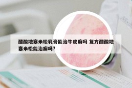 醋酸地塞米松乳膏能治牛皮癣吗 复方醋酸地塞米松能治癣吗?