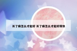 长了癣怎么才能好 长了癣怎么才能好得快