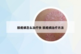 脓疱病怎么治疗快 脓疱病治疗方法