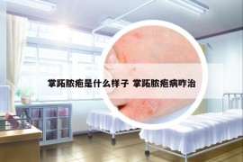 掌跖脓疱是什么样子 掌跖脓疱病咋治