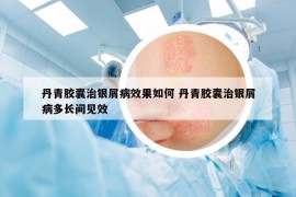 丹青胶囊治银屑病效果如何 丹青胶囊治银屑病多长间见效