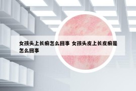 女孩头上长癣怎么回事 女孩头皮上长皮癣是怎么回事