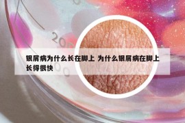 银屑病为什么长在脚上 为什么银屑病在脚上长得很快