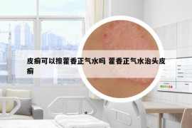 皮癣可以擦藿香正气水吗 藿香正气水治头皮癣