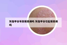 灰指甲会导致银屑病吗 灰指甲会引起银屑病吗