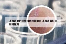 上海最好的皮肤科医院是那家 上海市最好皮肤科医院